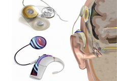 an image showing Internal and External device device of the cochlear implant