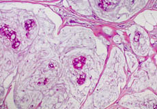 صورة مجهرية لسرطان الثدي
