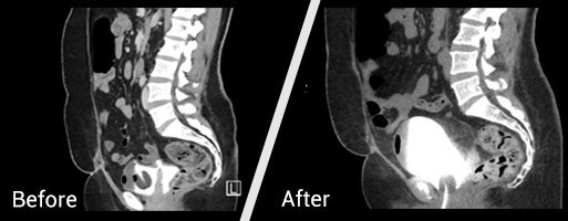 x-ray before and after Bladde​​r Fistula