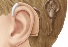 an image showing Internal and External device device of the cochlear implant